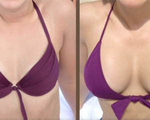 Equívocos comuns sobre mamoplastia de aumento e mastopexia